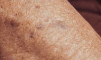 Long-Term Sun Damage