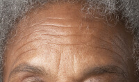 Skin Aging