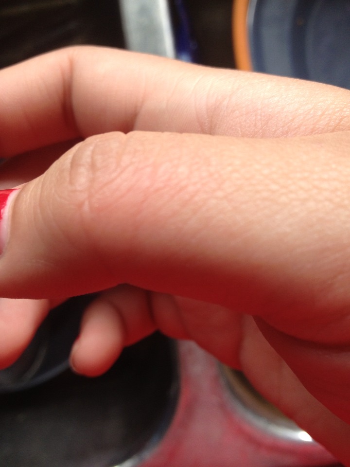 "2 Easy Steps To Get Rid Of Grease Burn Stings 👍👍😃!!" Musely