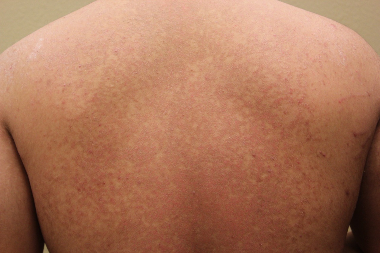 How To Get Rid Of Those White Spots From Tanning Musely