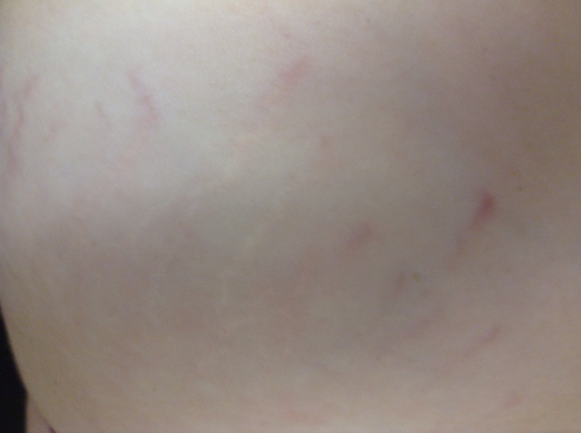 How To Fade Stretchmarks Musely