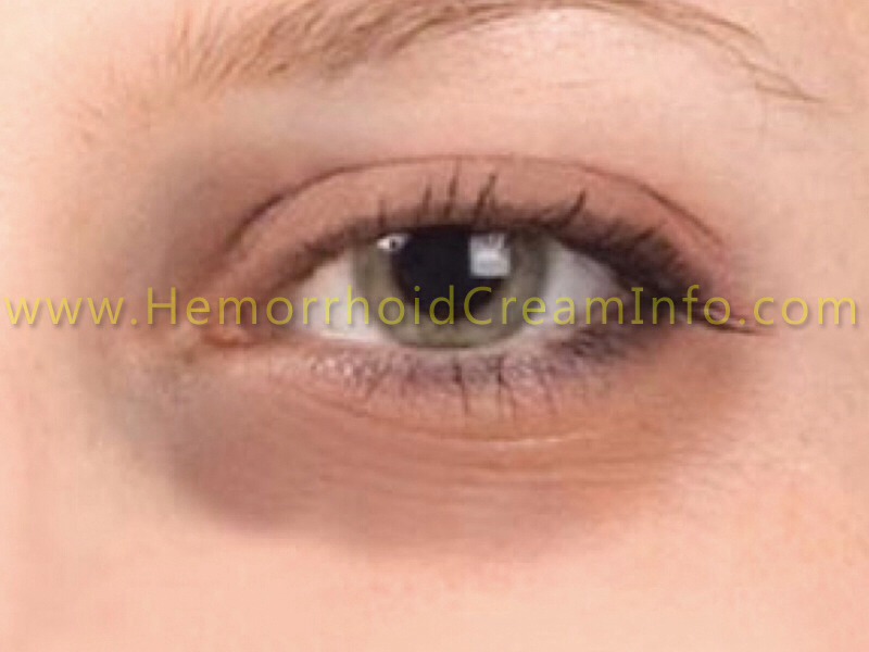 Hemorrhoid Cream Reduces Puffy Under Eye Bags Musely