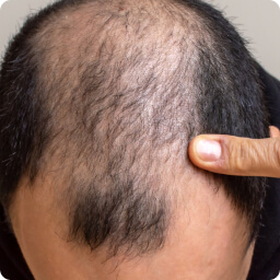 Thinning Hair