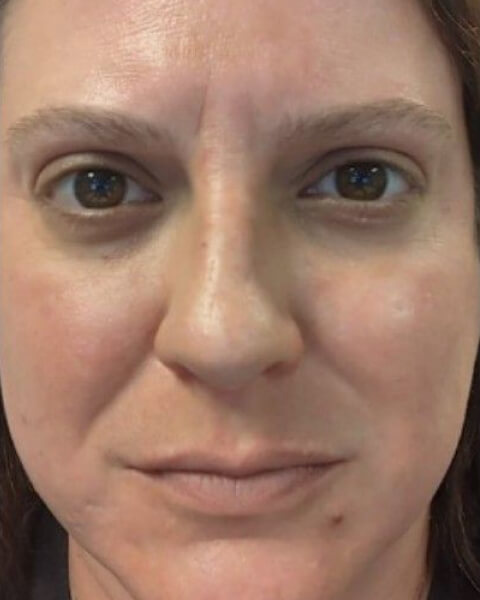 Melasma Treatment Dark Spot Corrector Musely Spot Cream Melasma Treatment Dark Spot Corrector Musely Spot Cream