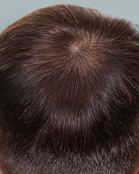 Male Pattern Baldness Solution - Real Results