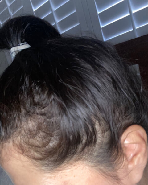 Topical Hair Regrowth for Women - Success Stories