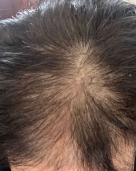 Dermatologist-Backed Hair Regrowth - Before & After