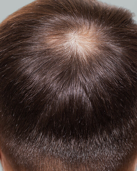 Men's Hair Regrowth Treatment - Before & After Photos