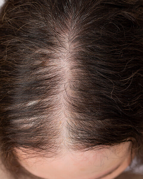 Female Hair Regrowth Treatment - Visible Results