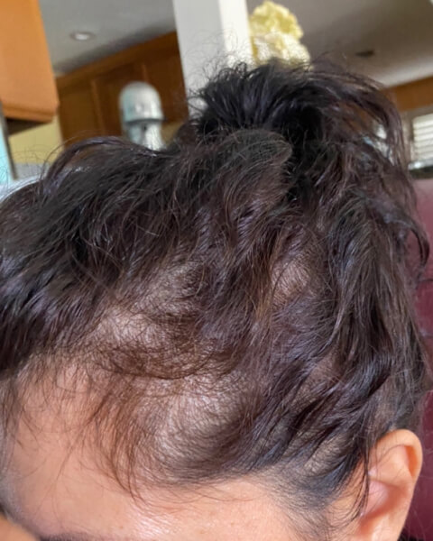 Prescription Hair Loss Solution - Real Results