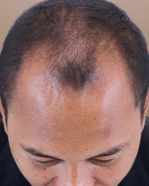 Topical Hair Growth for Men - Success Stories