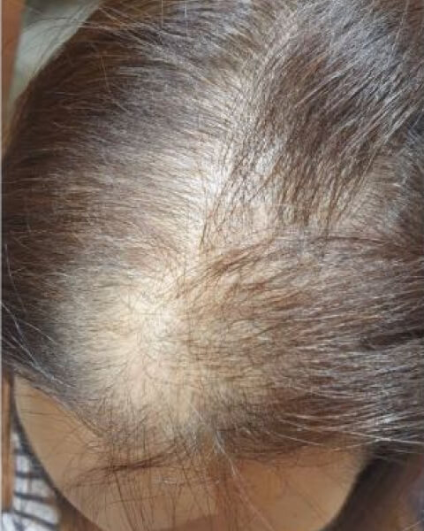 Hair Growth Results - Photos & Testimonials