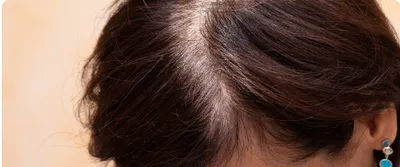 Musely Topical Dutasteride Aging Hair Treatment