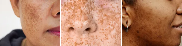 Dark Spots