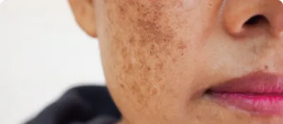 Musely Dark Spot Eliminator Cream