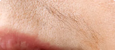 Musely Facial Hair Removal Treatment