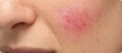Musely Rosacea Treatment
