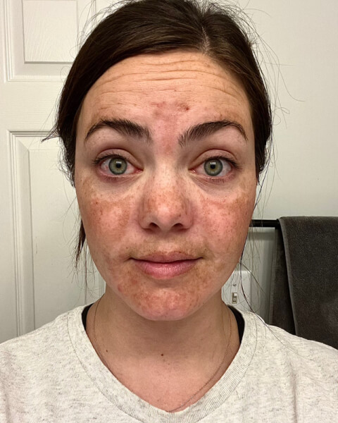 Abigail N. before treatment