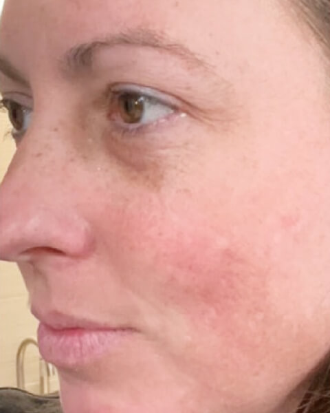 Andrea A. after treatment