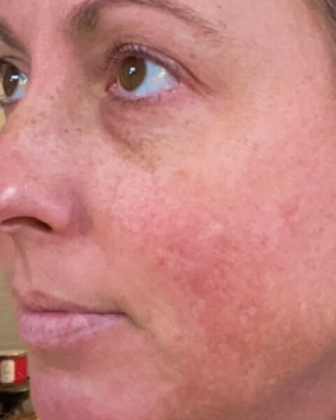 Andrea A. before treatment