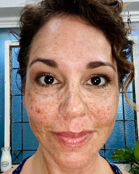 Anissa L. before treatment