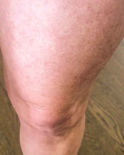 Ashley S. after treatment