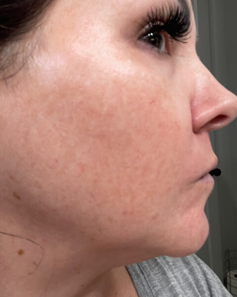 Autumn L. after treatment