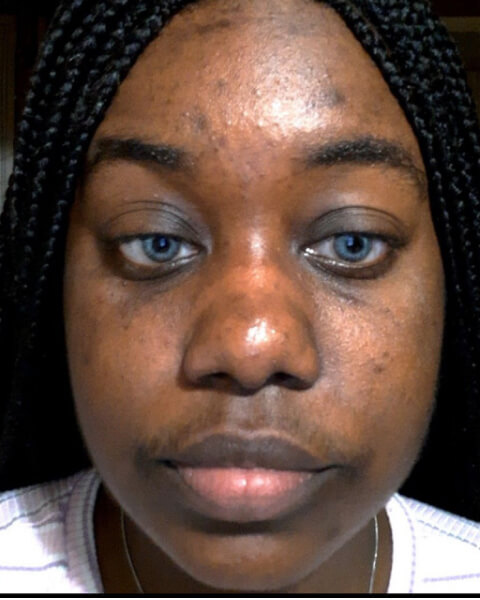 Bennita N. before treatment