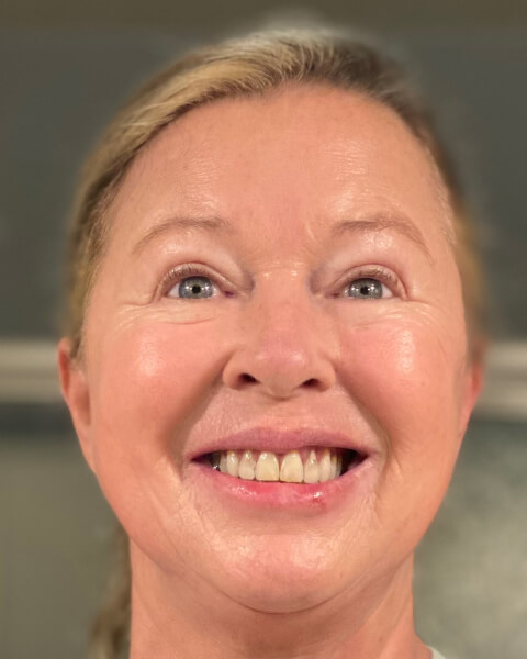 Billie C. after treatment