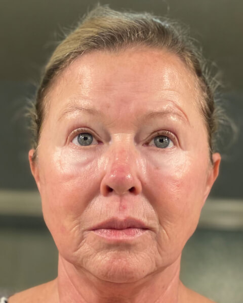 Billie C. before treatment
