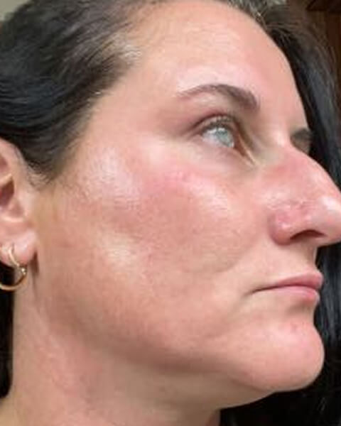 Brandy C. after treatment
