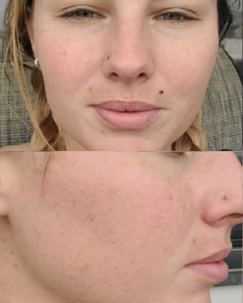 Brandy H. after treatment