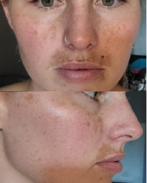 Brandy H. before treatment