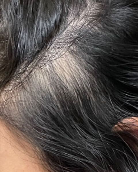 Candrian A. after treatment