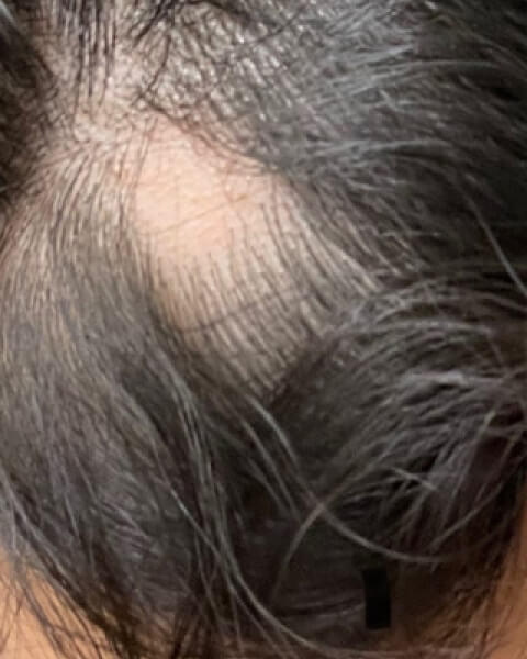 Candrian A. before treatment
