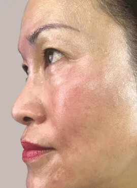 melasma cream before and after