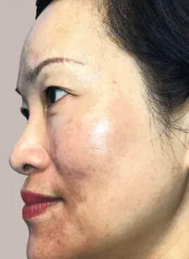 before and after dark spot treatment