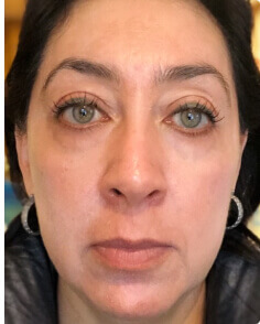 Claudia B. after treatment