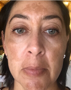 Claudia B. before treatment