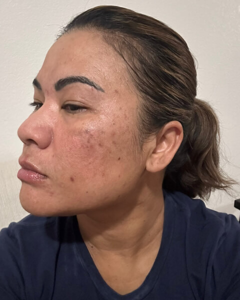 Connie A. after treatment