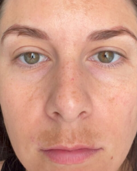 Danielle before treatment
