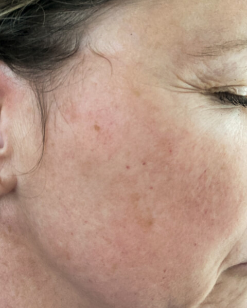 DeAnn G. after treatment