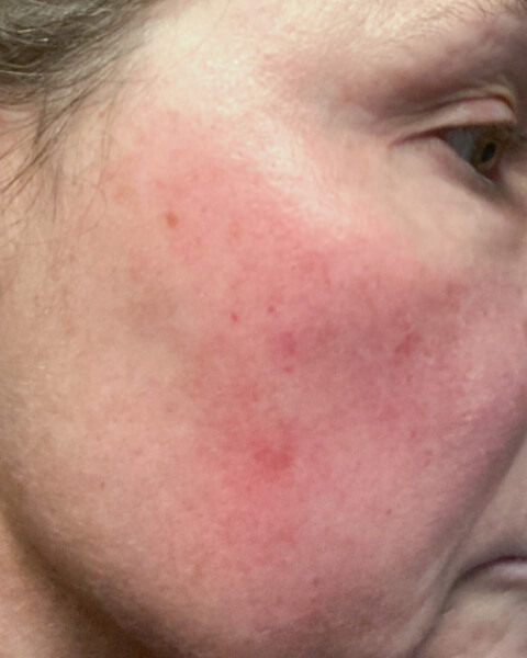 DeAnn G. before treatment
