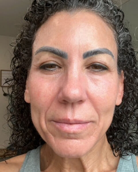 Denise O. after treatment
