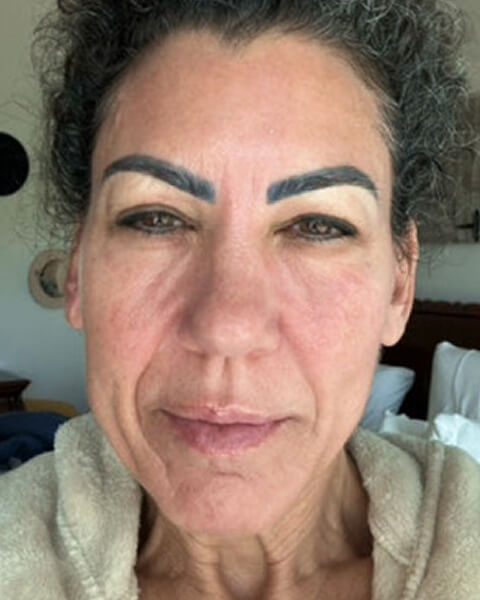 Denise O. before treatment