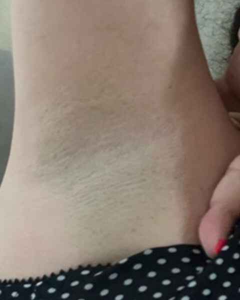 Doris G. after treatment