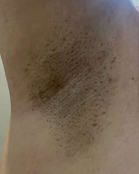 Doris G. before treatment