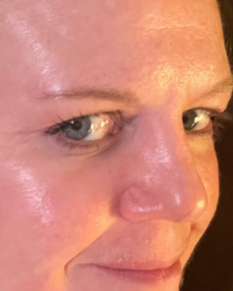 Erinne M. after treatment