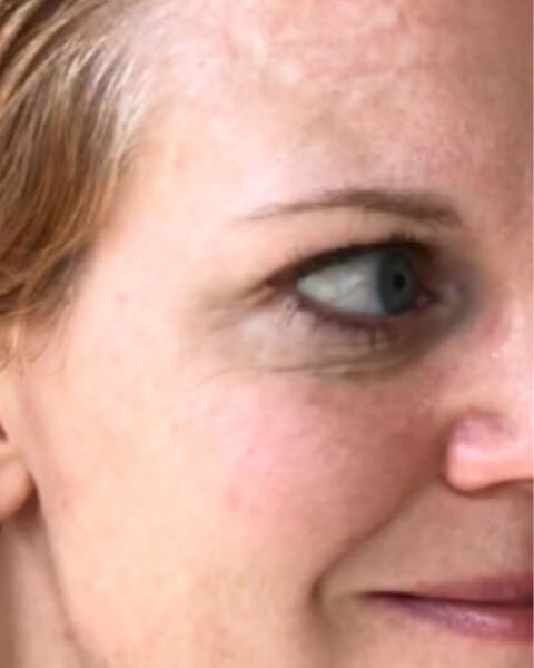 Erinne M. before treatment