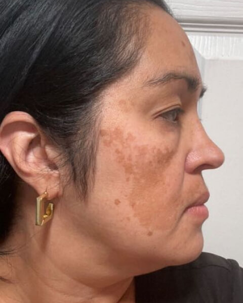 Gina H. before treatment